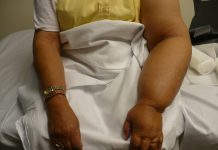 Georgia Tech gets $2 million to study lymphedema